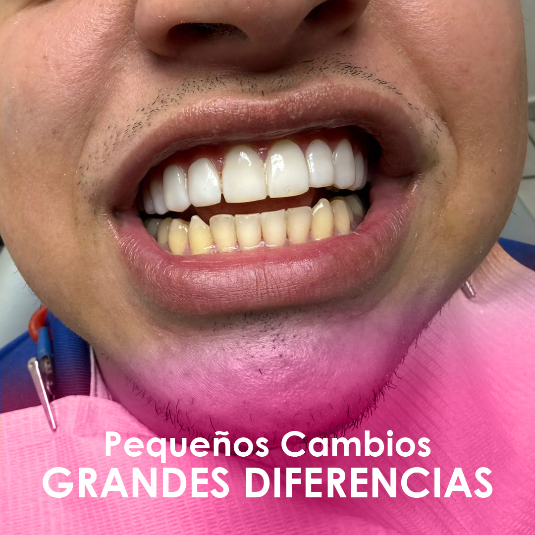 Diseño de sonrisa real — Perla Estética Dental Guadalajara